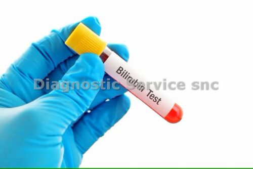 Total bilirubin 150/180 tests